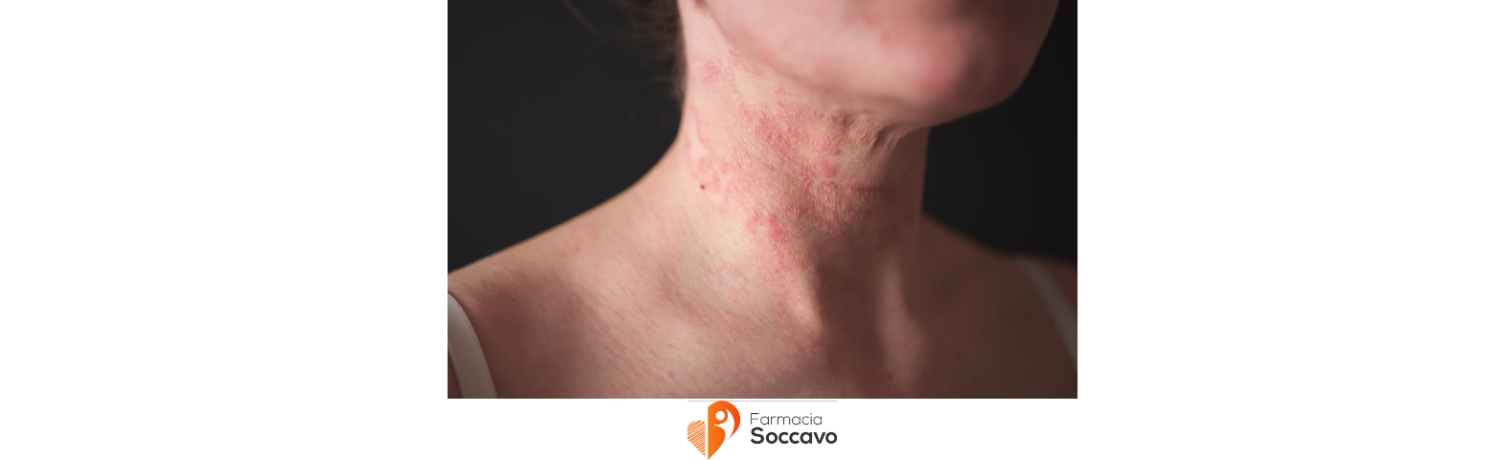 Come prevenire e trattare la dermatite atopica