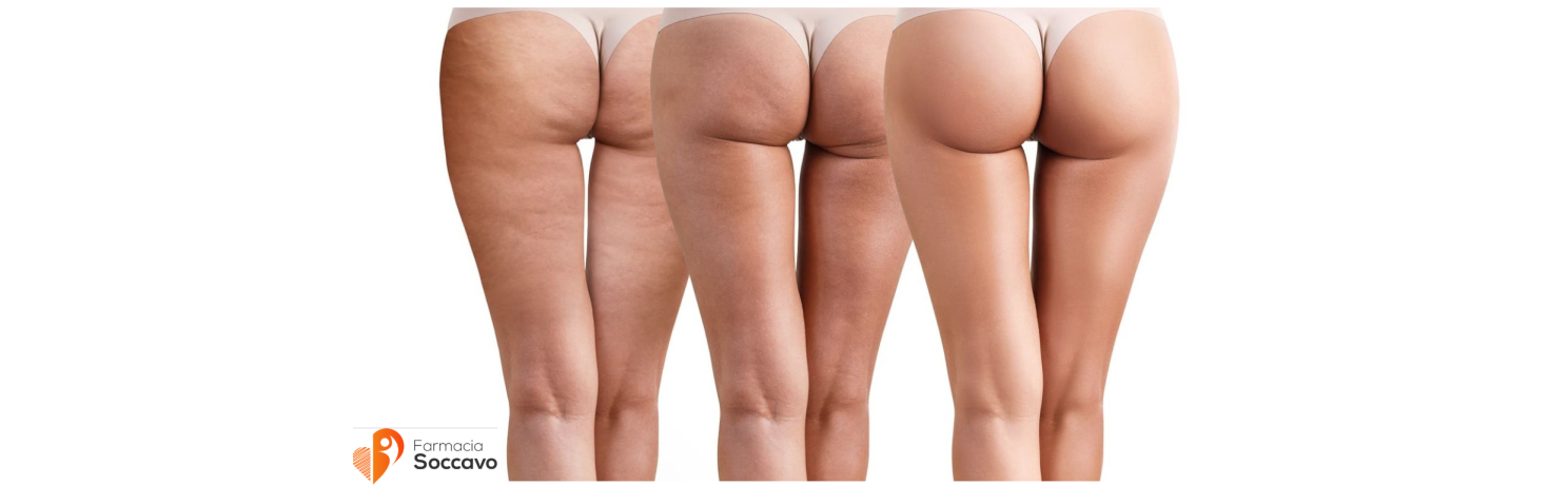 Rimedi naturali per la cellulite, soluzioni efficaci per dire addio agli inestetismi