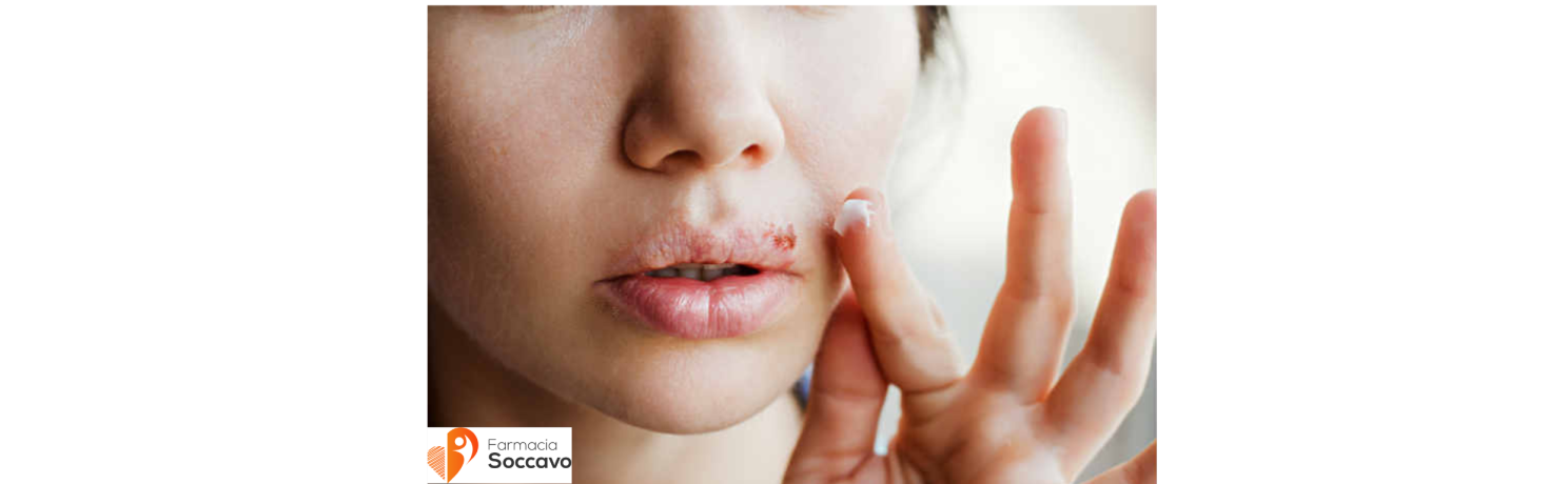 Herpes al naso: cause e rimedi farmacologici