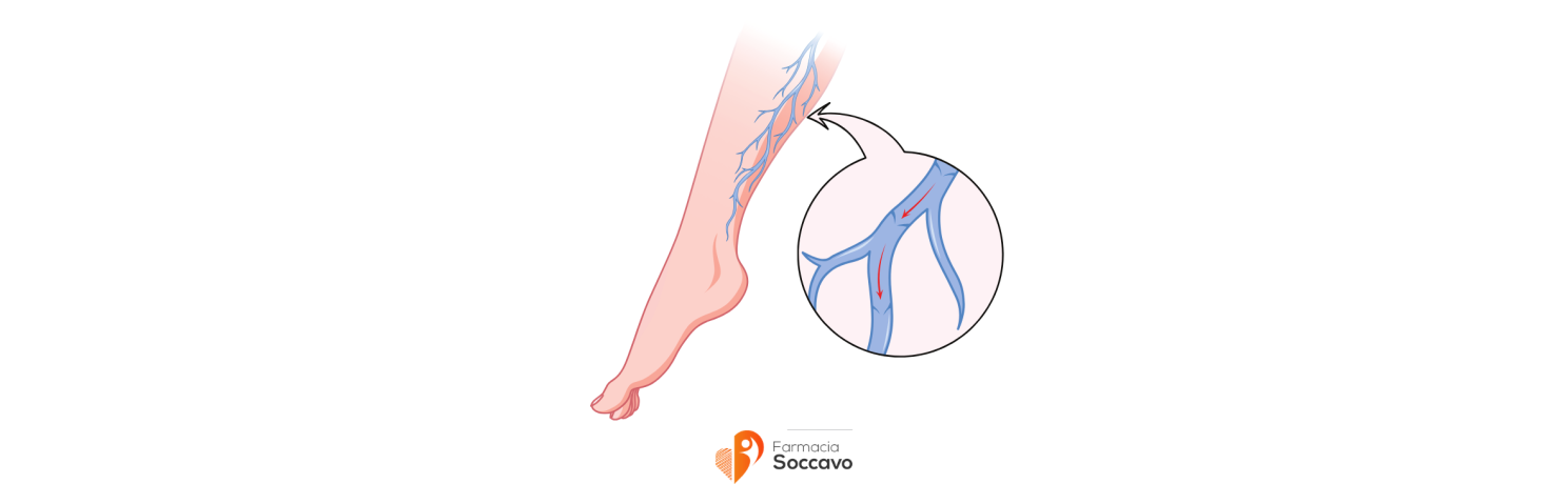 Vene Varicose: Rimedi, Trattamenti e Prevenzione Efficace