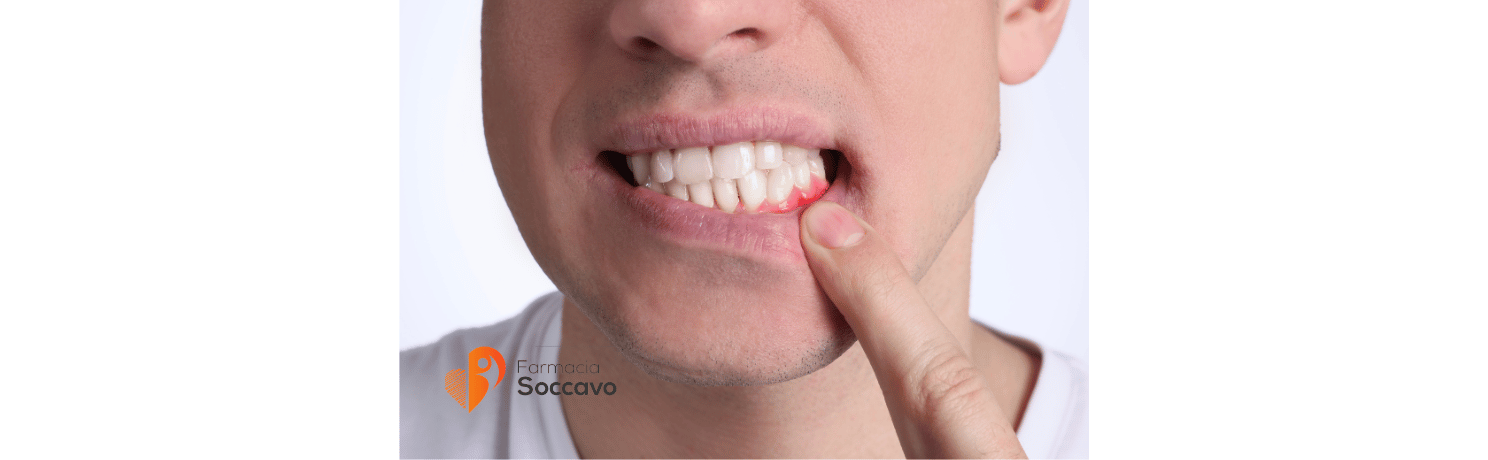 Afte, Stomatite e Gengive Infiammate: Cause, Sintomi e i Migliori Rimedi per il Cavo Orale