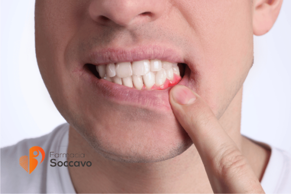 Afte, Stomatite e Gengive Infiammate: Cause, Sintomi e i Migliori Rimedi per il Cavo Orale