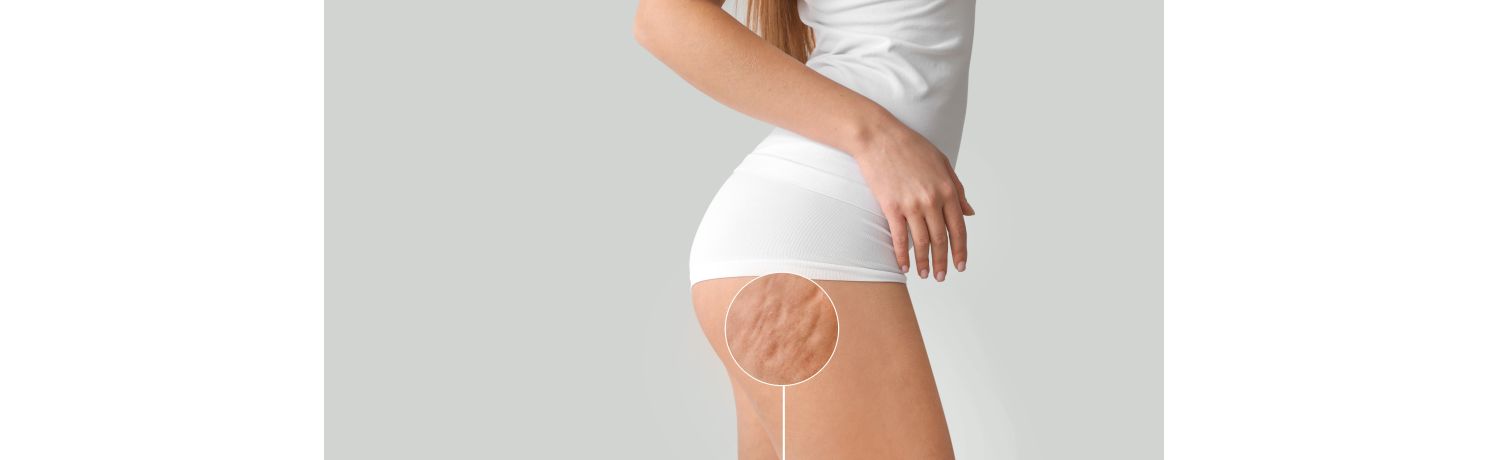 Bende per cellulite