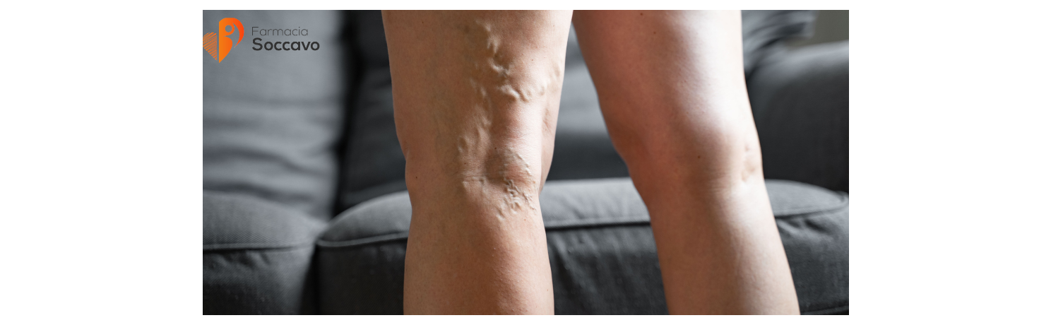 Gambe Gonfie e Pesanti in Estate: Rimedi Naturali e Integratori per la Circolazione