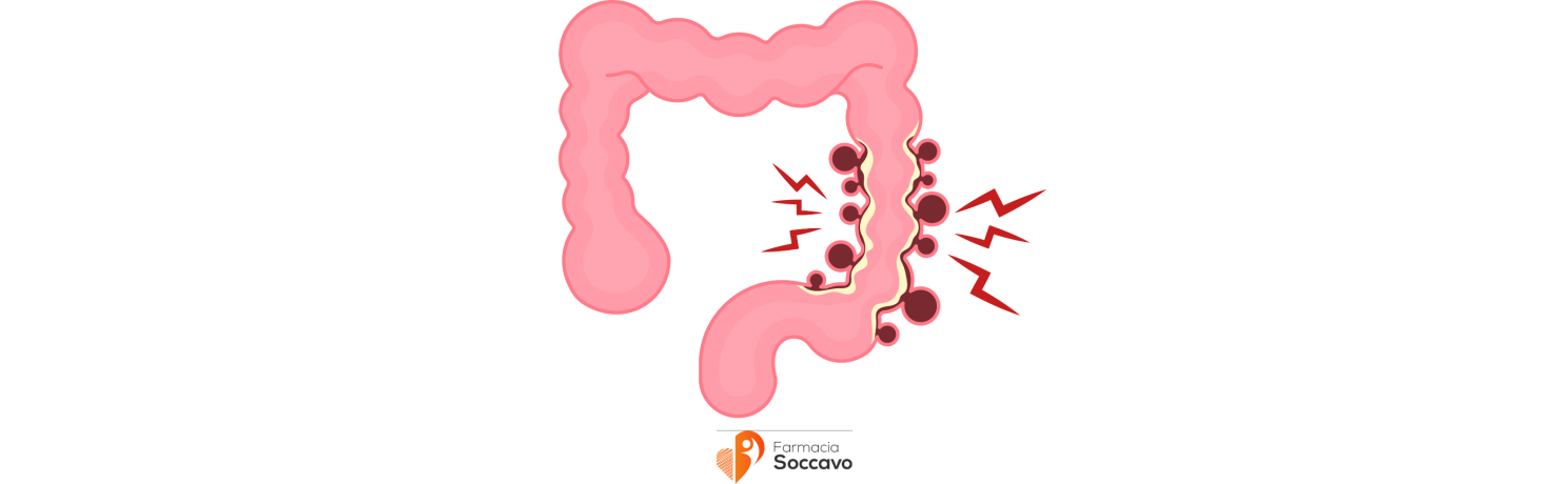 Strategie Efficaci per Combattere l'Infiammazione Intestinale: Scopri i Potenti Antiinfiammatori