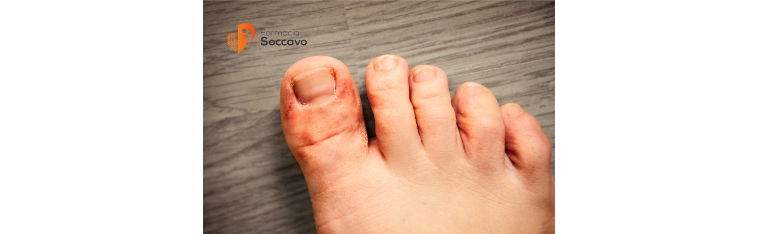 Micosi Cutanee e Piede d'Atleta: Sintomi, Cause e Rimedi Efficaci