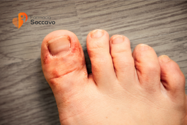 Micosi Cutanee e Piede d'Atleta: Sintomi, Cause e Rimedi Efficaci