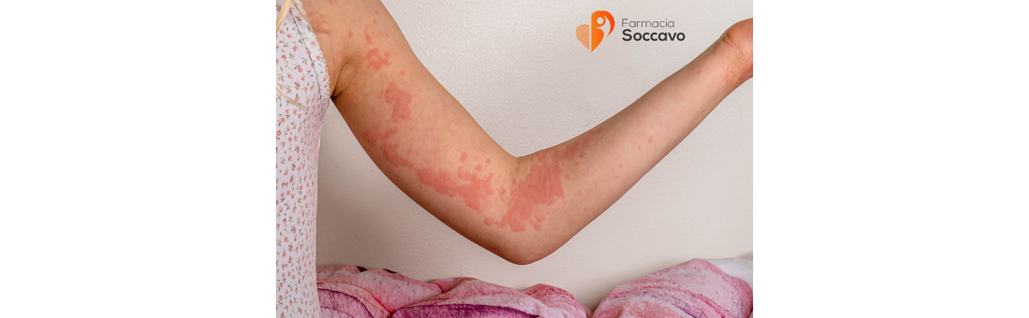 Orticaria e Reazioni Cutanee: Cause, Sintomi e Come Calmare il Prurito