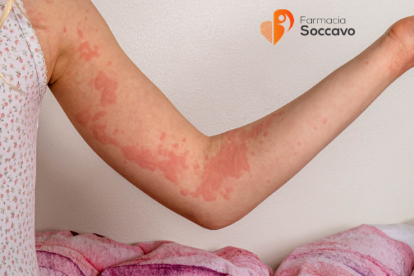 Orticaria e Reazioni Cutanee: Cause, Sintomi e Come Calmare il Prurito
