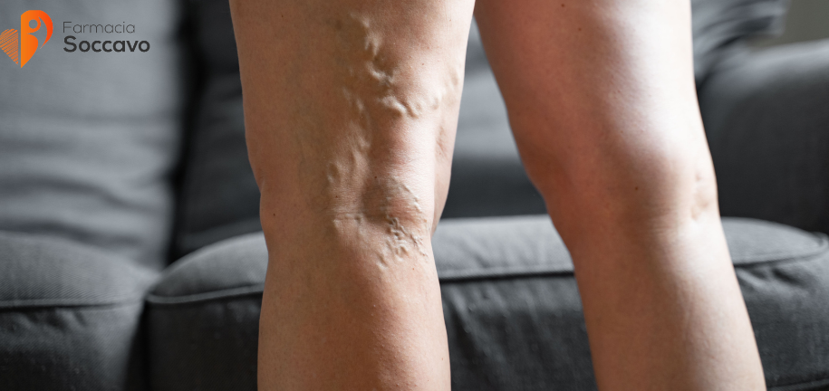 Gambe Gonfie e Pesanti in Estate: Rimedi Naturali e Integratori per la Circolazione Gambe Gonfie e Pesanti in Estate: Rimedi Naturali e Integratori per la Circolazione