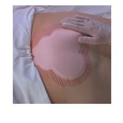 Medicazione Idrocellulare Adesiva Sterile Conformata Per La Regione Sacrale Assorbente In Schiuma Di Poliuretano Allevyn Sacrum 22,5x22,1cm 10pezzi