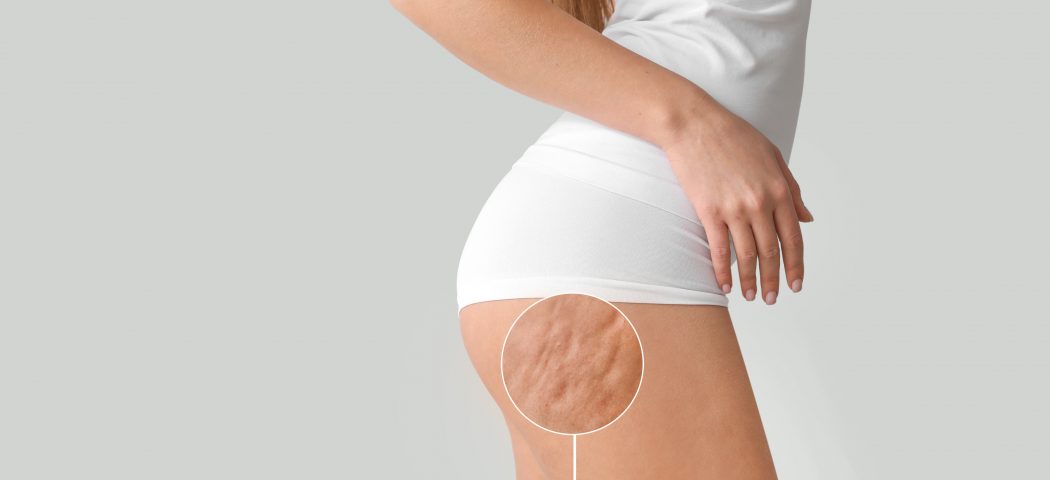 Bende per cellulite: come usarle e quanto sono efficaci