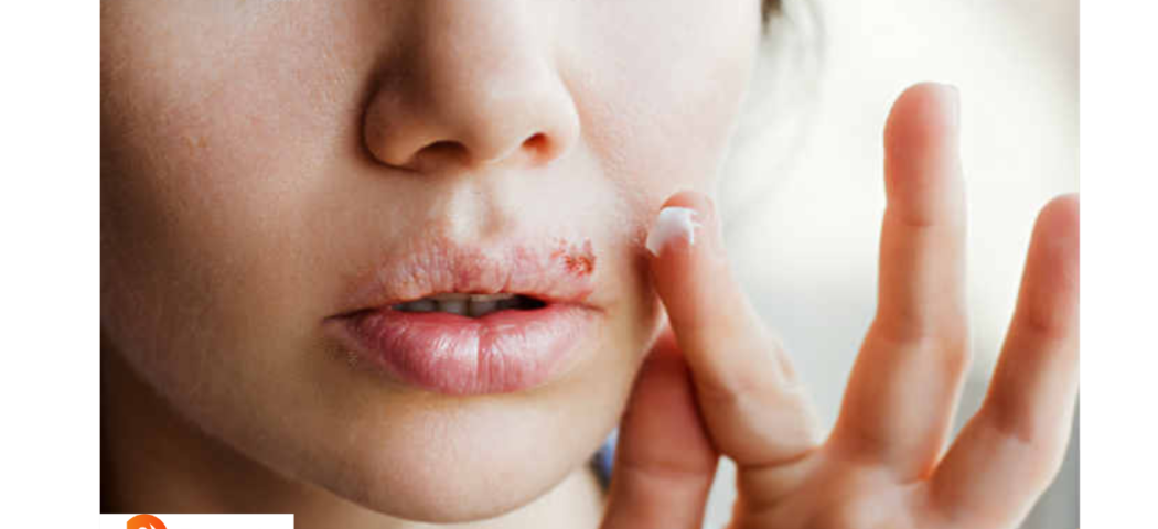 Herpes al naso: cause e rimedi farmacologici