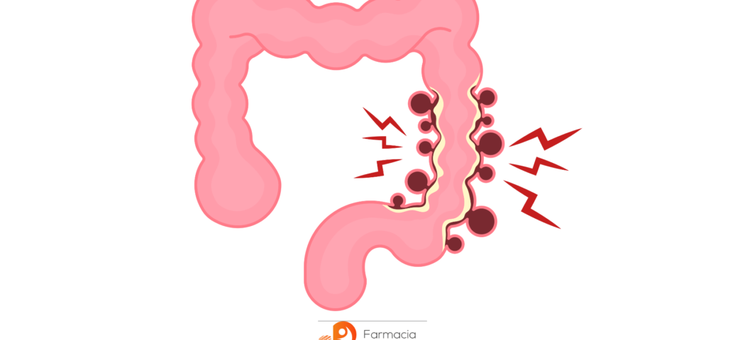 Strategie Efficaci per Combattere l'Infiammazione Intestinale: Scopri i Potenti Antiinfiammatori