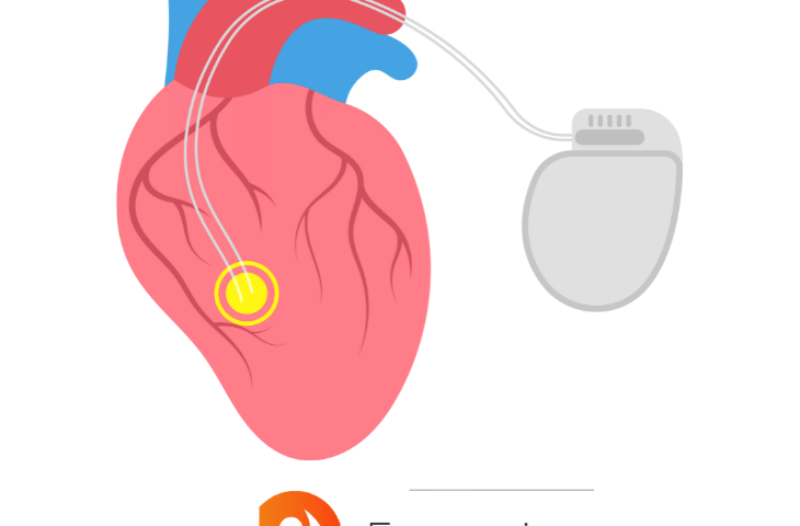 Holter Cardiaco - ECG a Napoli: Scopri le Differenze e Prenota il Tuo Esame Gratuito su FarmaciaSoccavo.it